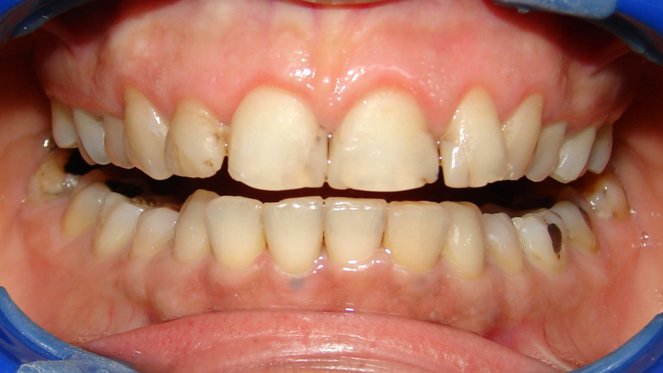 Smile Treatment in India