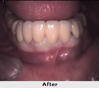 Cosmetic Dental Treatment