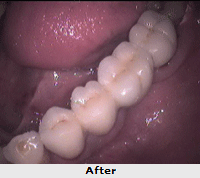 Pediatric endodontics In Mumbai