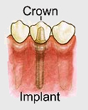DENTAL IMPLANTS,INDIA