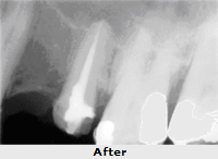 Root Canal Treatment in India