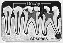 Teeth whitening in India