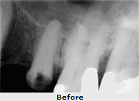 Dental Root Canal