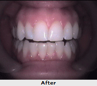 Dental Implants in India