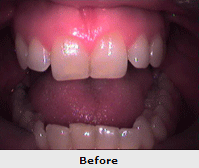 Teeth Whitening Treatment